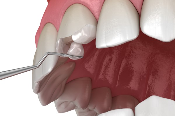 Popular General Dentistry Tooth Repair Procedures