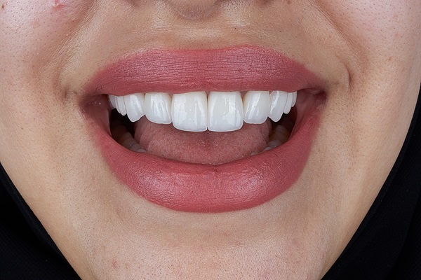 How Dental Bonding Can Restore Your Smile