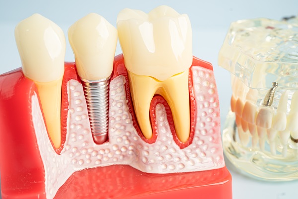 What Full Mouth Dental Implants Are