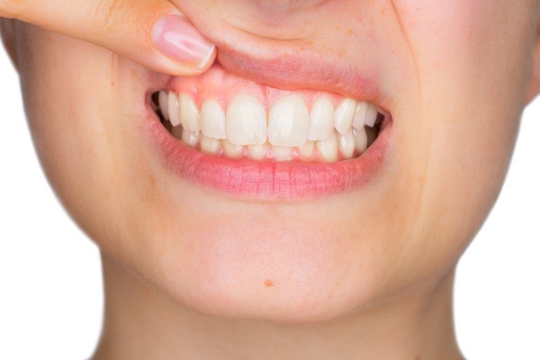 receding gums stages